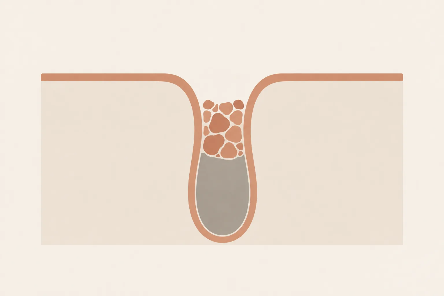 Simple cross-section diagram of a pore: a narrow channel blocked near the surface with clustered shapes, drawn in flat terracotta and gray.